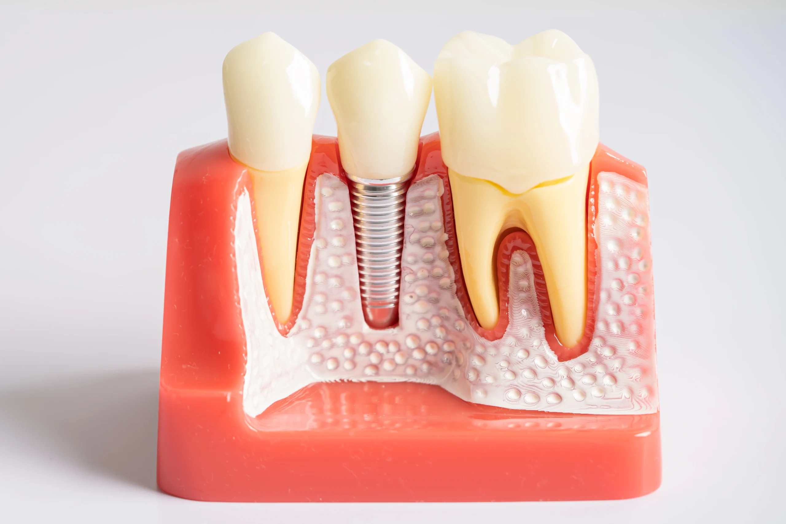 Dental implants in Towson