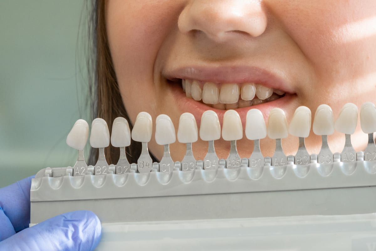 Veneers in Timonium