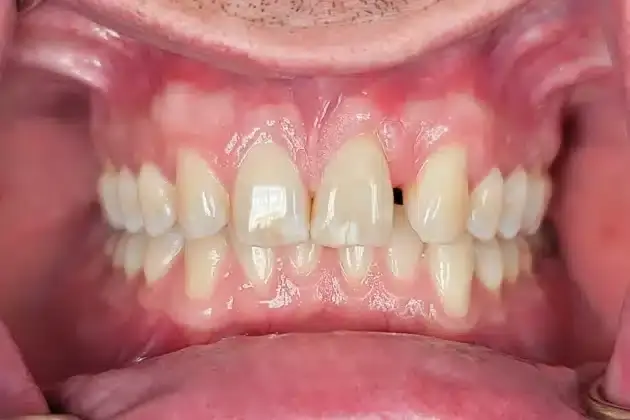 Before cosmetic dentistry treatment showing misaligned teeth with uneven spacing and discoloration.