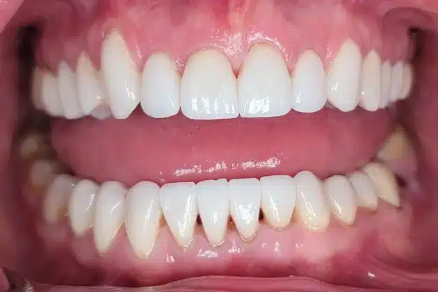 cosmetic dentistry smile restoration after
