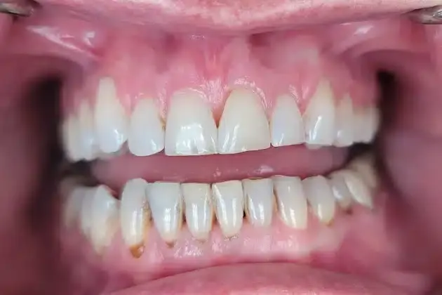 Before cosmetic dentistry smile restoration showing discolored and misaligned teeth in Towson.
