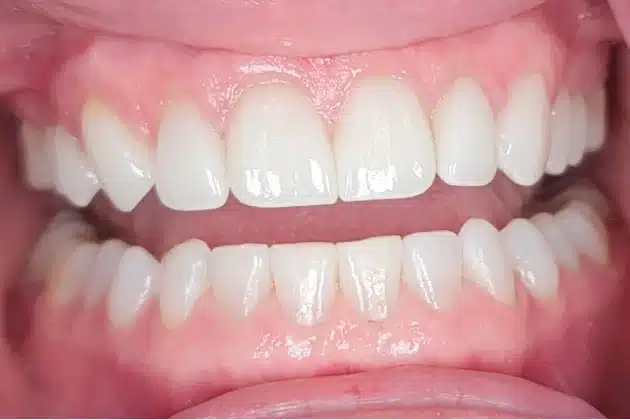 porcelain veneers smile makeover after