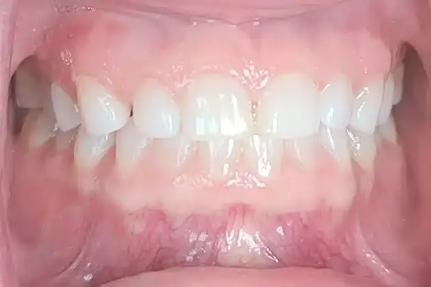 Before porcelain veneers smile makeover showing uneven tooth alignment and discoloration.