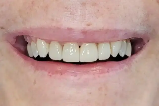 Smile makeover result showing patient's bright, evenly spaced white teeth after cosmetic dental treatment.