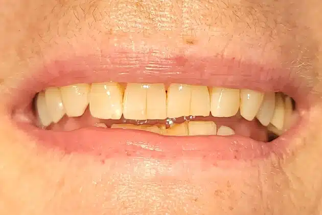 smile makeover before